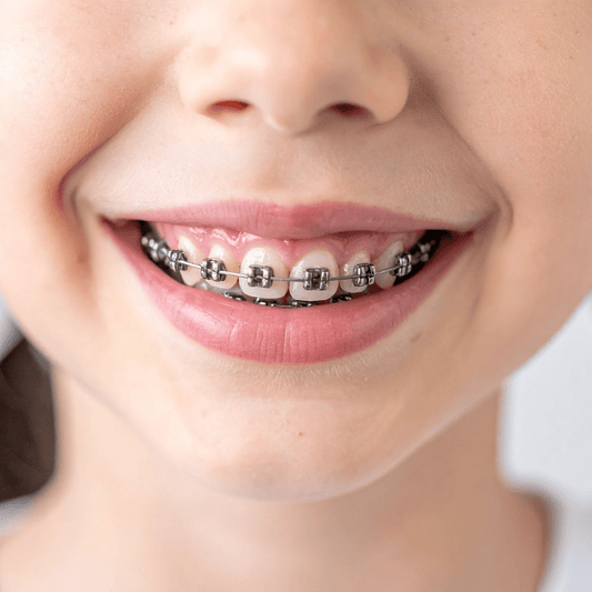 SDF for Children with Braces: What Parents Need to Know About Protecting Teeth - Proactive Baby